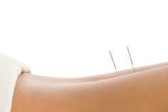 Acupuncture in back of woman Picture